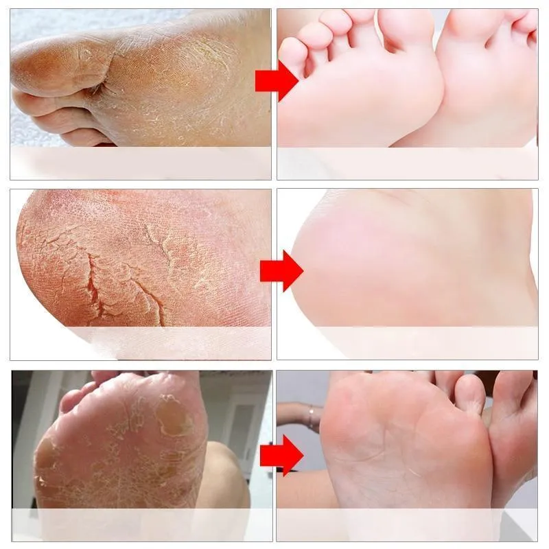 BabySkin™ Ultimate Foot Peeling Mask